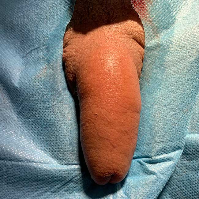 Powiększanie penisa kwasem hialuronowym — po zabiegu
